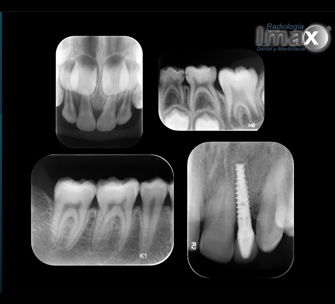 Radiografías bite wing y control de implante