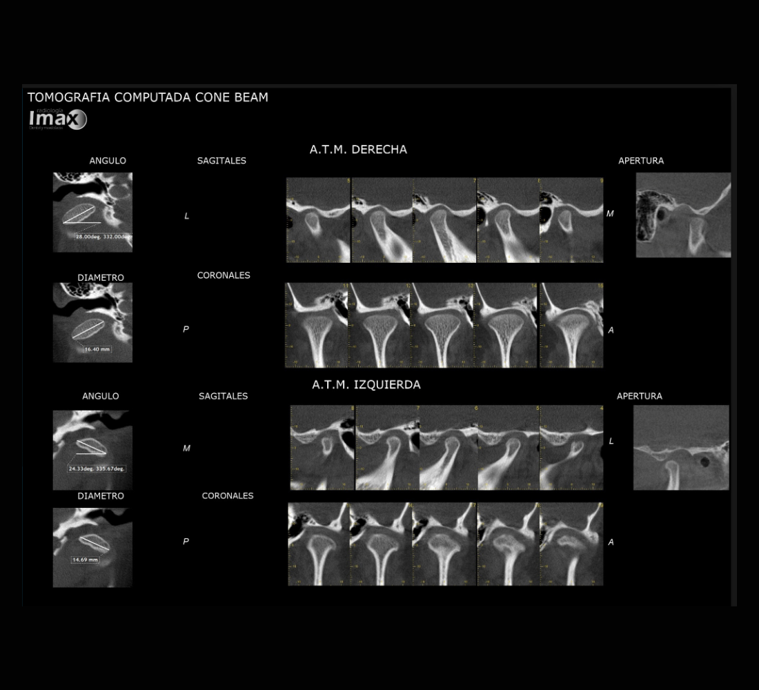 Tomografía Cone Beam de articulación temporomandibular (ATM)