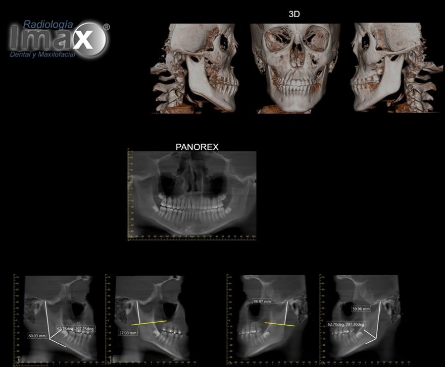 Tomografía Cone Beam FOV grande con reconstrucciones 3D y panorámica