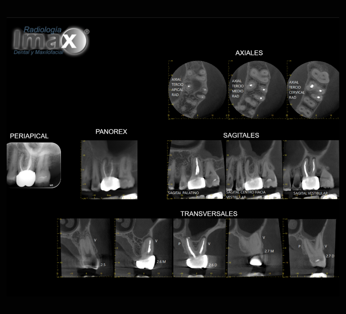 Informe de tomografía Cone Beam: cortes axiales, sagitales y transversales
