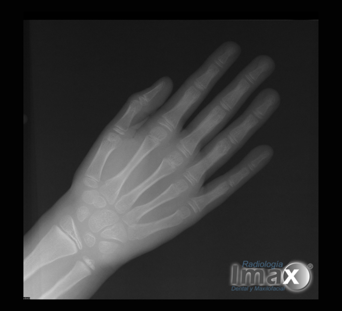 Radiografía de mano y carpo para edad ósea