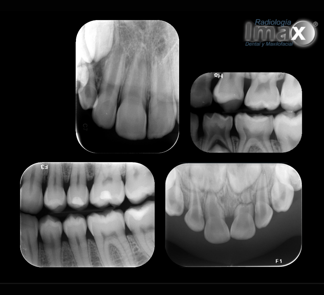 Serie de radiografías periapicales / retroalveolares