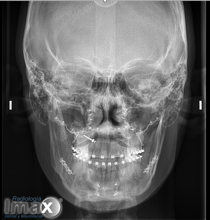 Telerradiografía frontal dinámica de cráneo
