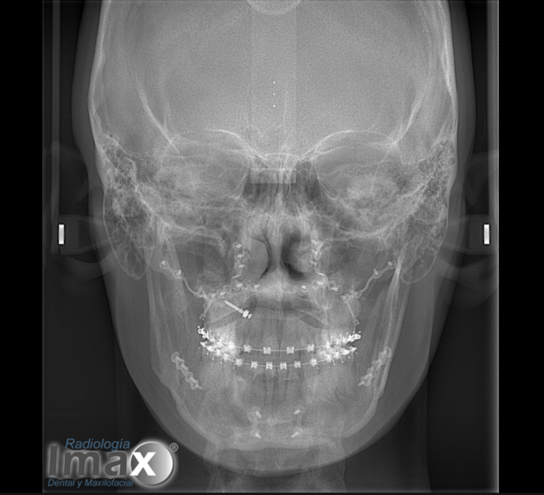 Telerradiografía frontal de cráneo