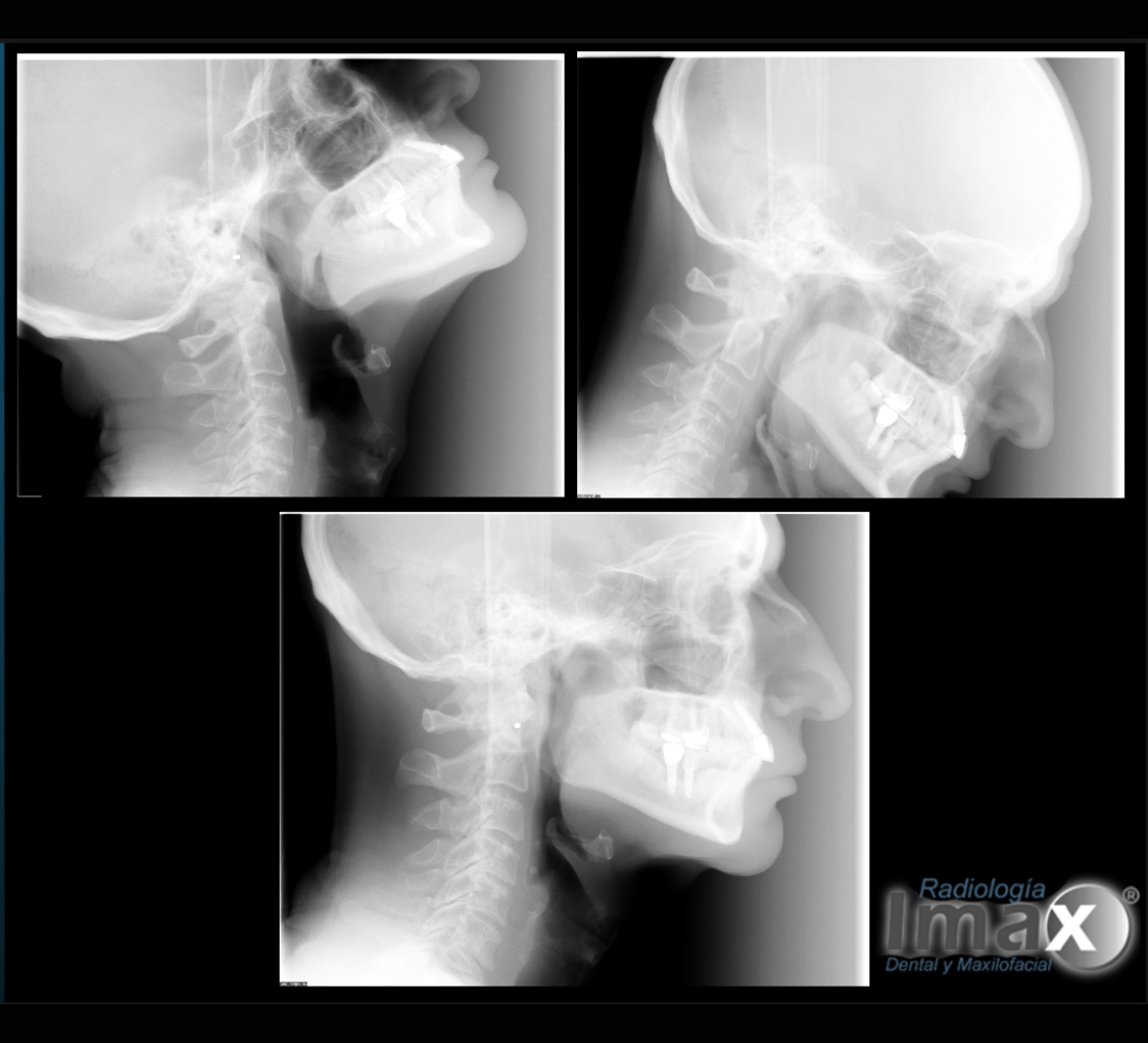 Telerradiografía lateral de cráneo