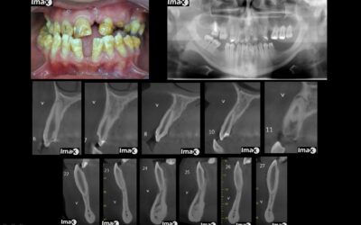 Caso 25 Amelogénesis imperfecta.