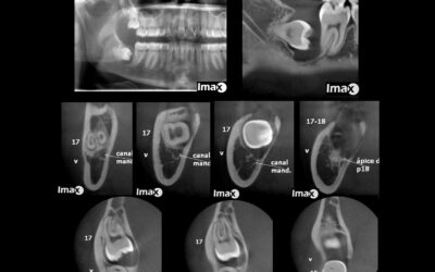 Caso 26 Quiste odontogénico queratoquiste.