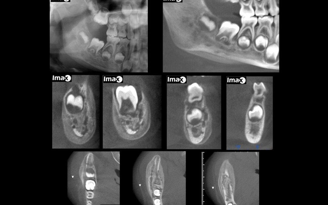 Caso 28 Osteomielitis crónica con periostitis proliferativa (Garré)