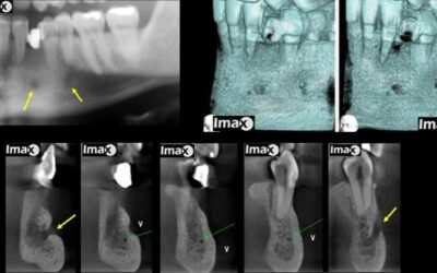 Caso 29 Doble foramen mentoniano.