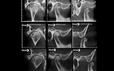 Caso 30 Erosión y remodelación de cóndilo mandibular.