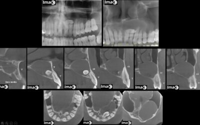 Caso 31 Quiste dentígero en relación con diente supernumerario.