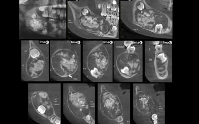 Caso 32 Fibro odontoma ameloblástico.