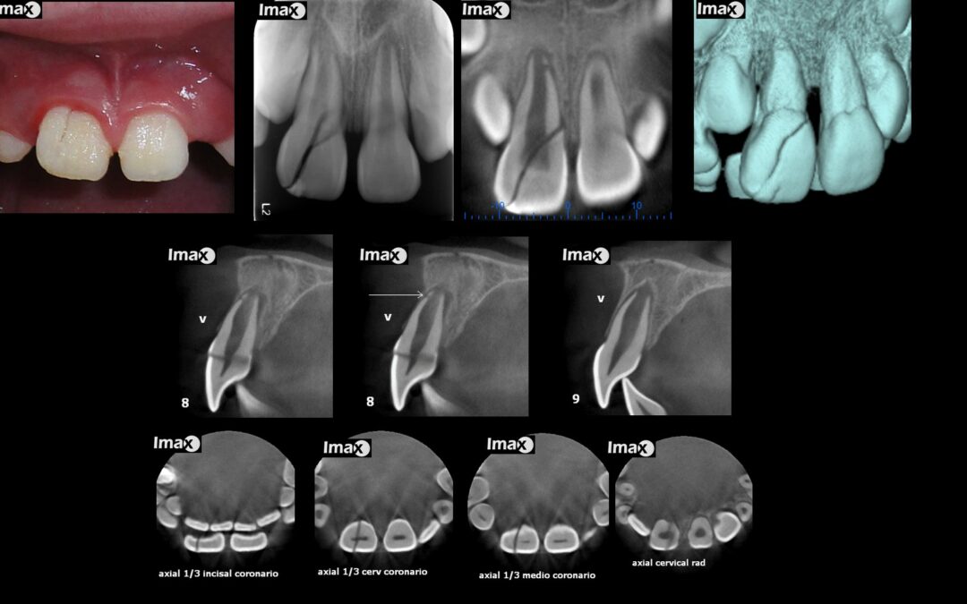 Caso 35 Fractura corono radicular y luxación diente 8.
