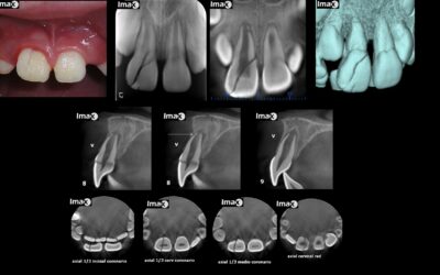 Caso 35 Fractura corono radicular y luxación diente 8.