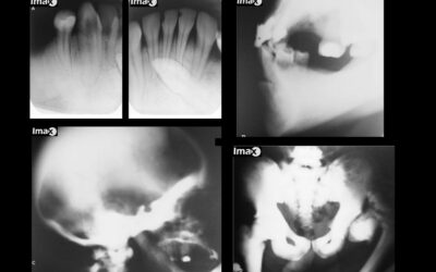 Caso 37 Osteopetrosis.