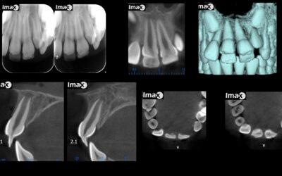Caso 38 Hipoplasia del esmalte. Diente de Turner.