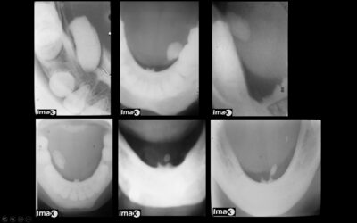 Casos 40-41 Cálculos salivales en el conducto submandibular.
