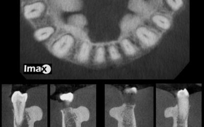 Caso 11 Torus linguales bilateral.