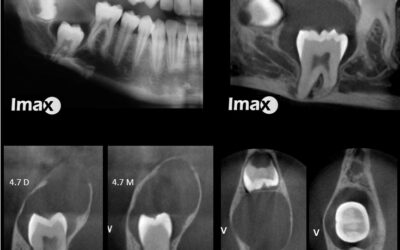 Caso 13 Quiste dentígero.