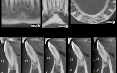 Caso 14 Displasia ósea periapical.
