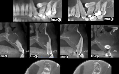 Caso 20 Quiste dentígero, transposición e invaginación del esmalte.