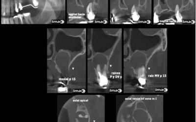 Caso 24 Quiste radicular inflamatorio invadiendo seno maxilar.
