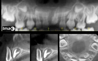 Caso 6 Traumatismo dento alveolar en niño.