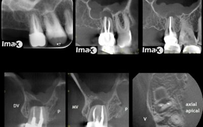 Caso 10 Aporte del Cone Beam en lesión apical.