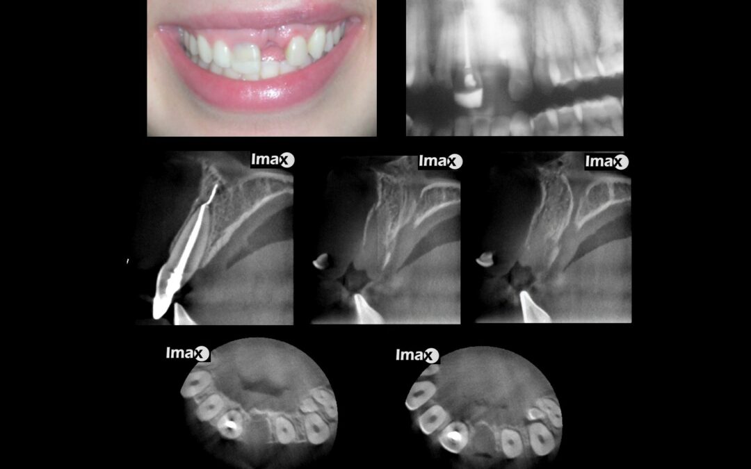 Caso 52 Avulsión diente 2.1 y fragmento de diente en tejidos blandos.