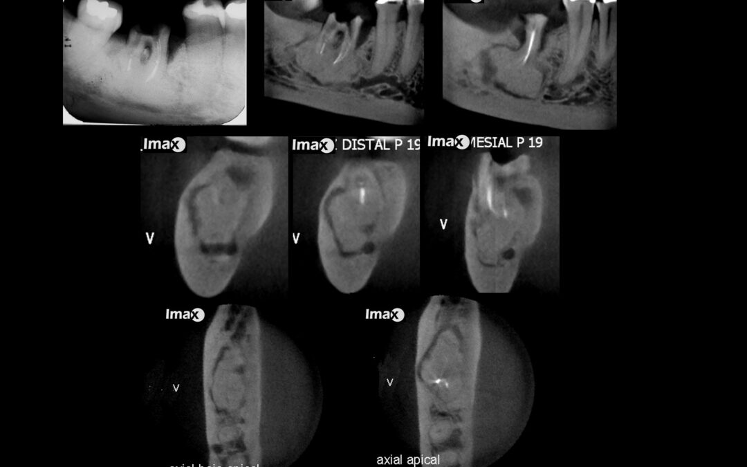 Caso 60 Cementoblastoma benigno asociado al primer molar inferior derecho.