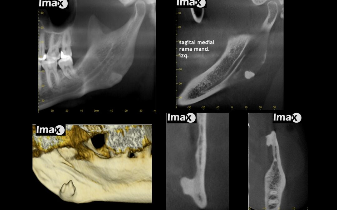 Caso 64 Osteoma periostal en ángulo mandibular izquierdo.