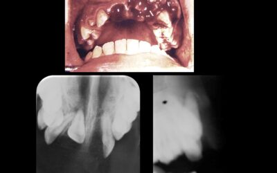 Caso 76 Traumatismo dento alveolar con avulsión del diente 2.1 y la luxación del 1.1.