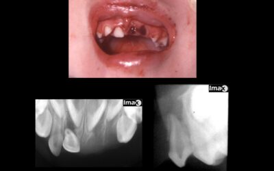Caso 91 Traumatismo dento alveolar en niño.