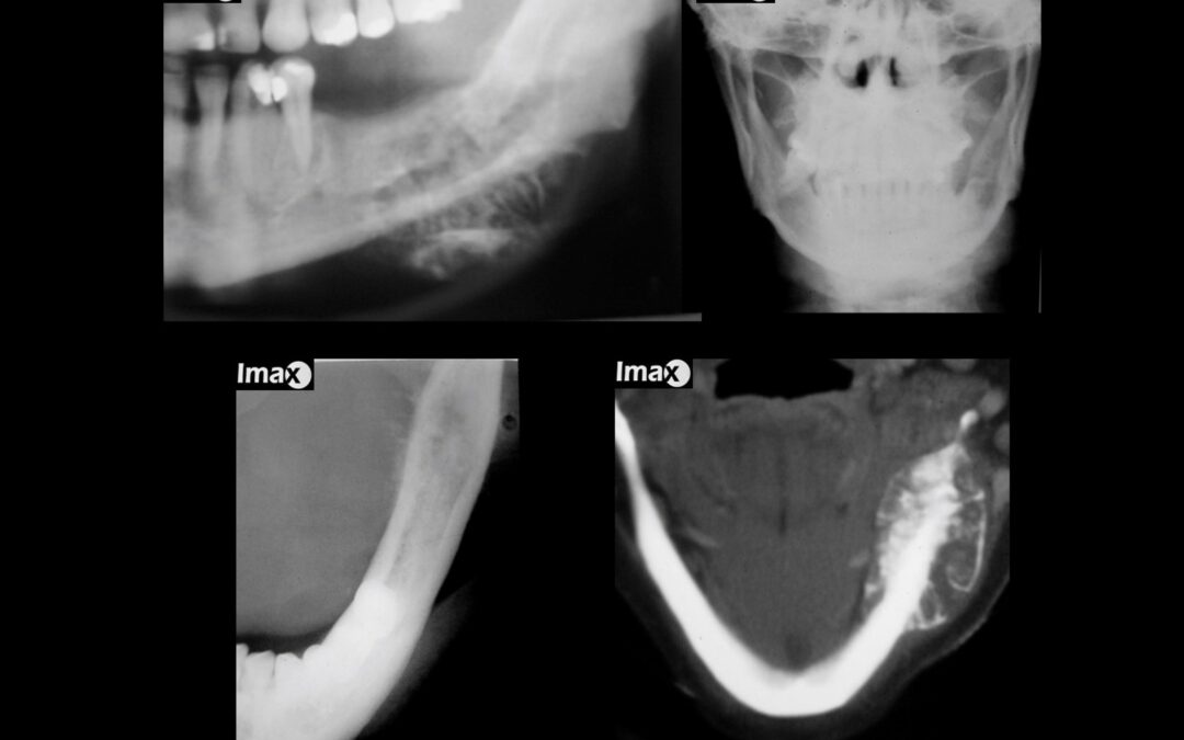 Caso 94 Osteosarcoma mandibular.